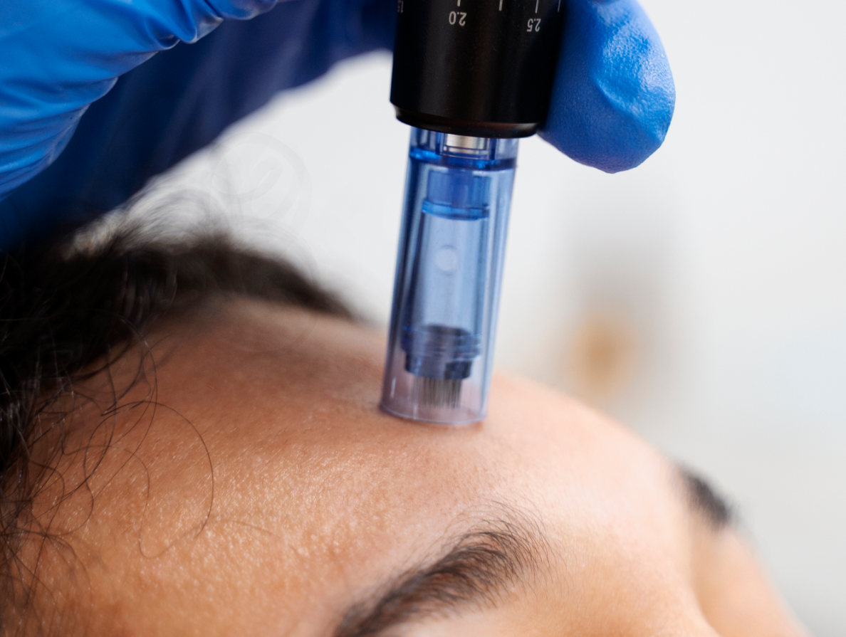 microneedling 01